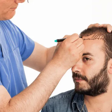 Hair Transplant