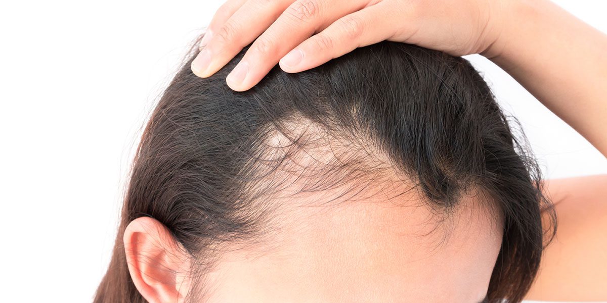 Mesotherapy For Hair Loss
