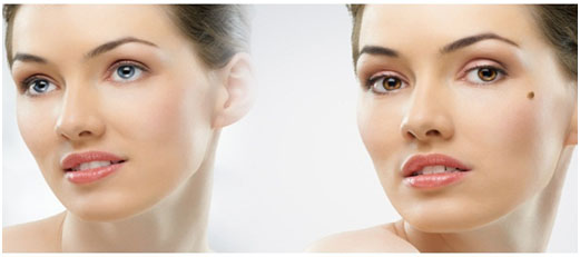 Removal of Moles, Warts and Keloids