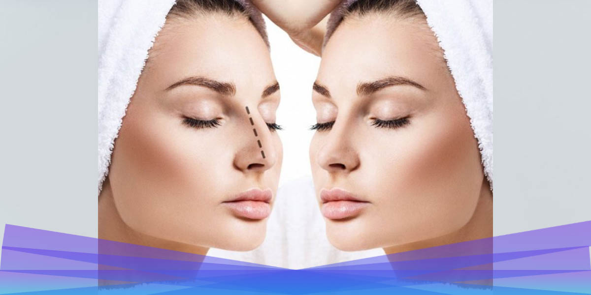 Rhinoplasty